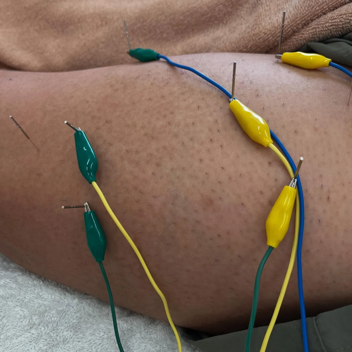 ハムストリング(大腿二頭筋)肉離れのパルス鍼治療🪡