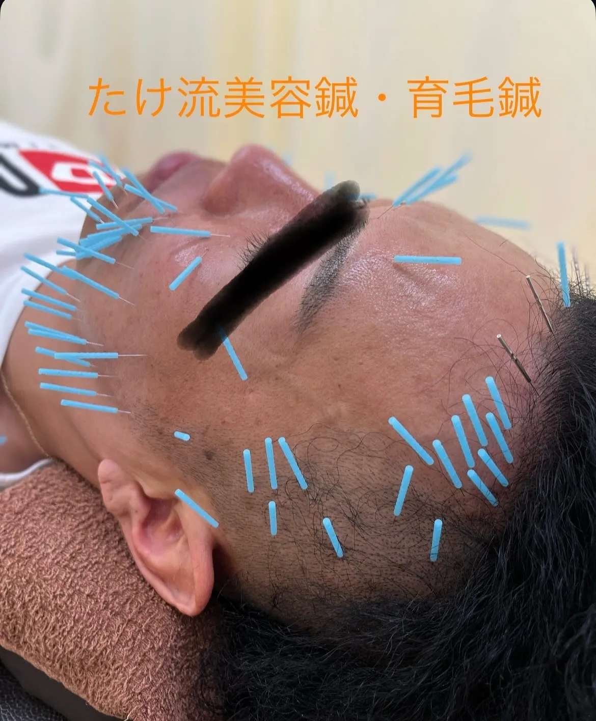 美容鍼❗️育毛鍼❗️ シワ、たるみ、ほうれい線、くま、シミ、...