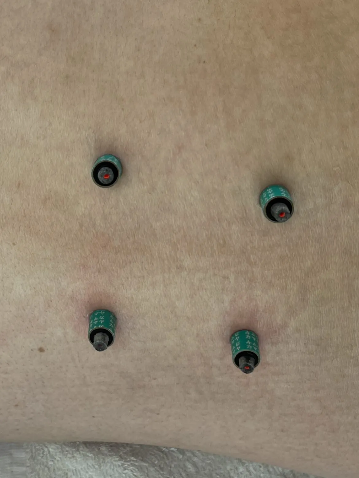 冷え症にはお灸治療が鉄板!!内臓の機能を高めることが末端の手...