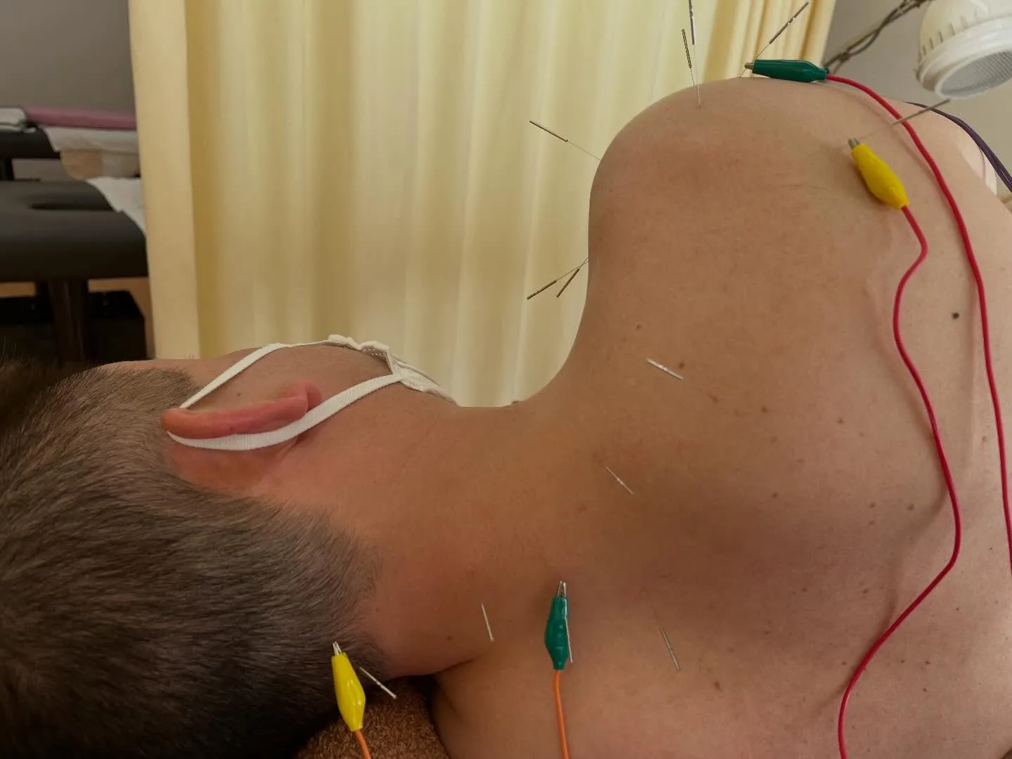 四十肩（肩関節周囲炎）鍼パルス電気治療がめちゃ効果高いです！...